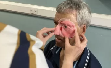 Мужчине восстановили лицо 3D-печатью